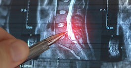 Life After a Spinal Cord Injury