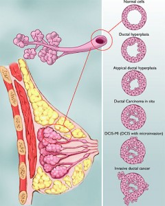 Atypical Hyperplasia