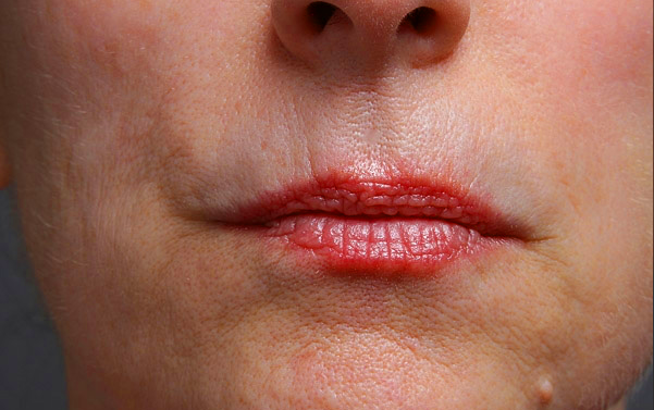 Perioral before.png