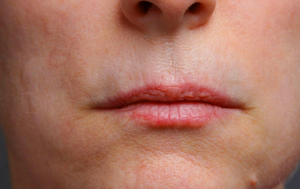 Perioral after.png