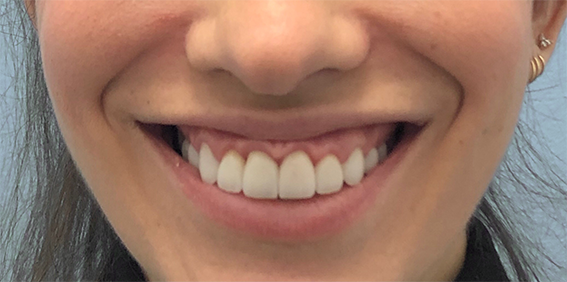 Gummy before.png