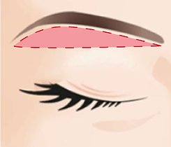 常見手術切口-02.png