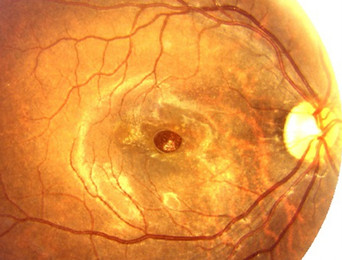 Macular hole OCT scan showing a full-thickness hole in the retina, diagnosed by retina specialist Dr. Mayank Bansal in Delhi