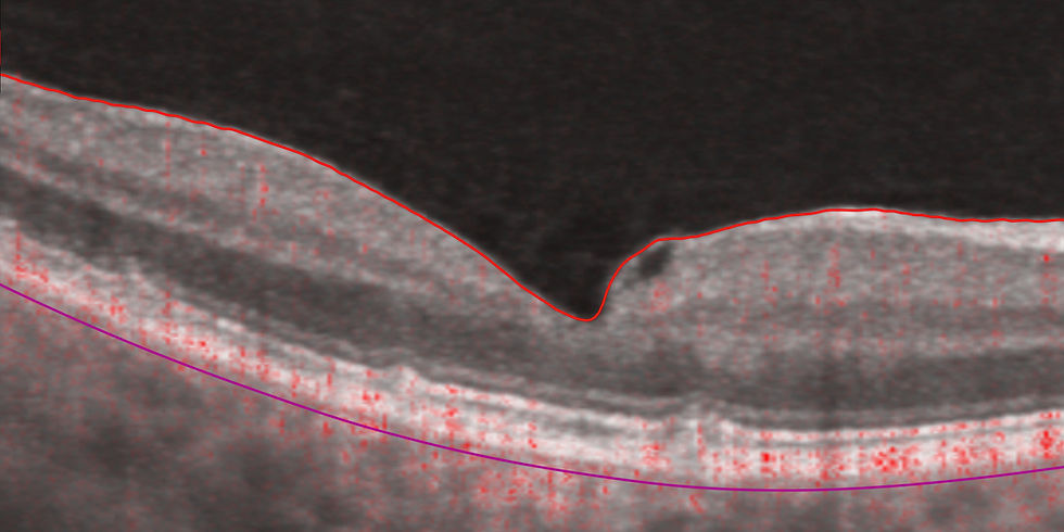RETINA ANGIOGRAPHY
