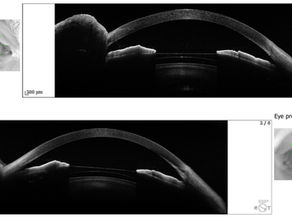 Implantable Collamer Lens (ICL) Surgery in Delhi: A Contemporary Method for Unobstructed Vision
