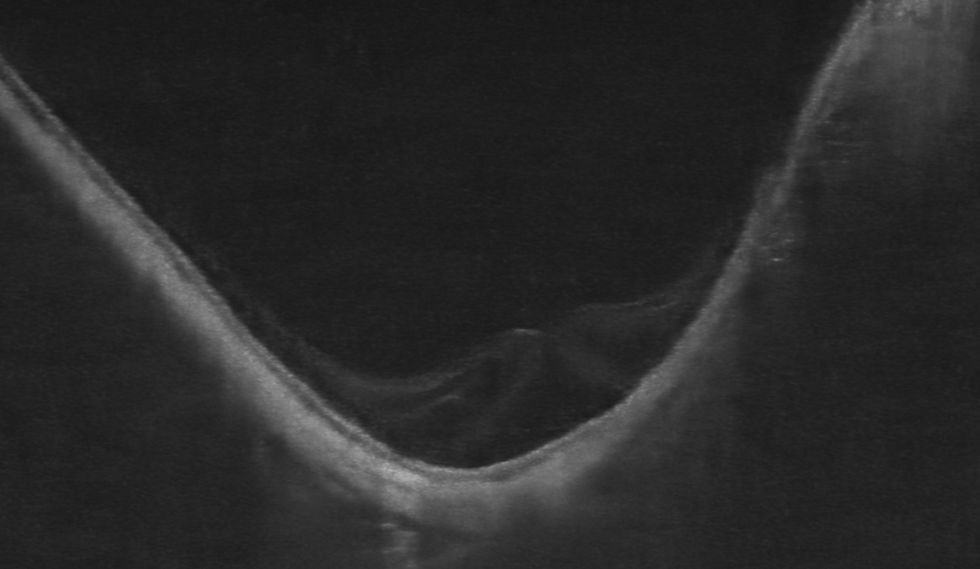 OCT IMAGE SHOWING MYOPIC MACULAR TRACTION MACULOPATHY ICLUDING MACULAR HOLE