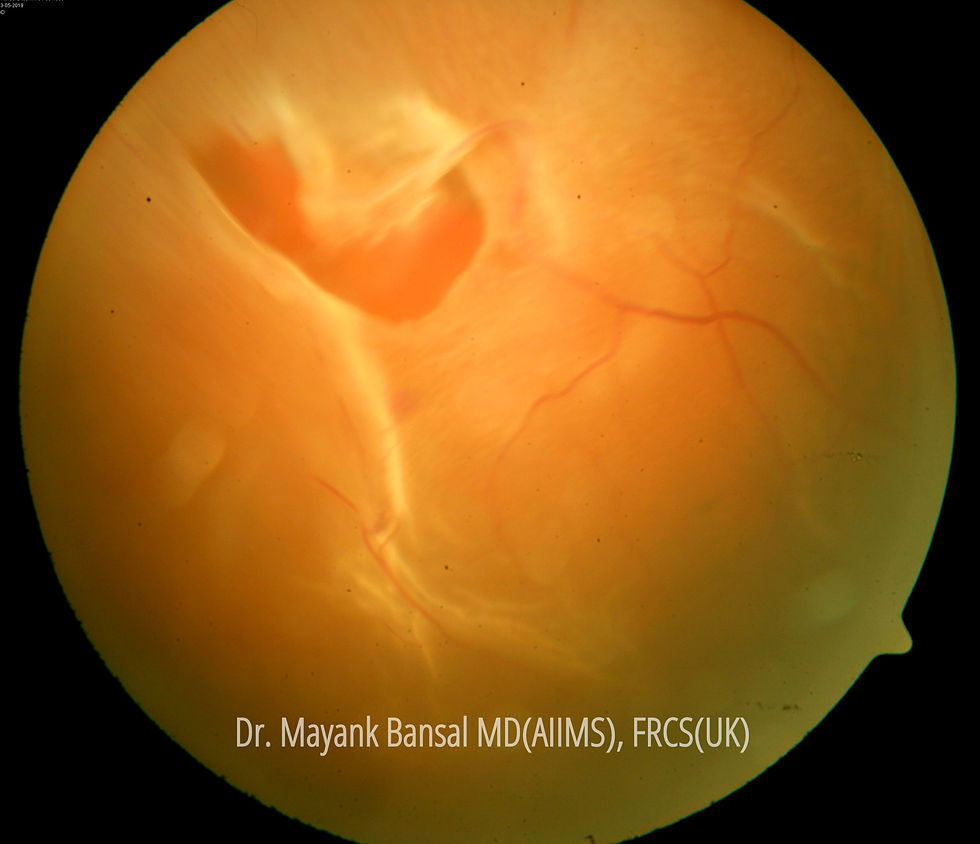 Retina Tear