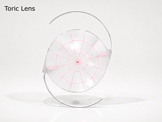 Toric Lenses for Cataract Surgery: Cost, Pros, Cons and Who They're For