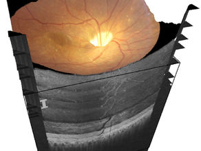 OCT & OCT ANGIOGRAPHY: HOW AN EYE SCAN IS A WINDOW INTO YOUR BRAIN
