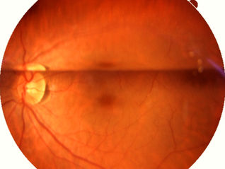 Gas or Silicone Oil? Understanding Tamponade Agents in Retina Surgery