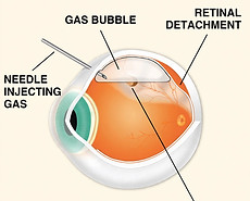 Gas bubble after retinal surgery in Delhi: the bubble holds the retina in place, is absorbed over a few weeks, and day-care surgery allows same-day home, by retina surgeon Dr. Mayank Bansal