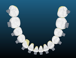 vue occlusale finale.png