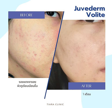 รีวิว Juvederm Volite ฟิลเลอร์ผิว ผิวเรียบเนียน - Tiara Clinic เทียร่าคลินิก คลินิกเสริมความงาม ลาดกระบัง