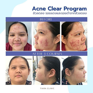 รีวิว ฉีดมาเด้ Made Collagen รักษาสิว สิวอักเสบ สิวฮอร์โมน สิวผื่น สิวผด สิวเรื้อรัง สิวสเตีรอยด์ - Tiara คลินิกความงาม ลาดกระบัง