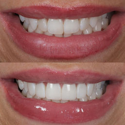 Cosmetic Dentistry in Birmingham Composite Bonding Veneers + Aligners