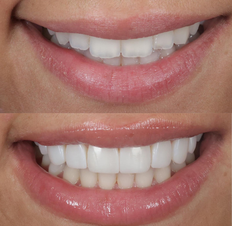 Cosmetic Dentistry in Birmingham Composite Bonding Veneers + Aligners 