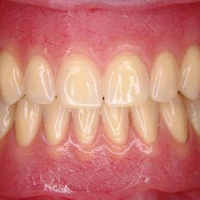 Desdentado total con protesis superior e inferior