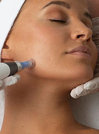woman on a treatment bed getting microneedling treatment