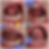 Frenuloplasty