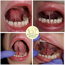 Severe tongue tie revision