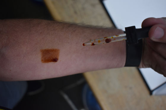 HOW TO PERFORM AN IODINE SKIN PATCH TEST
