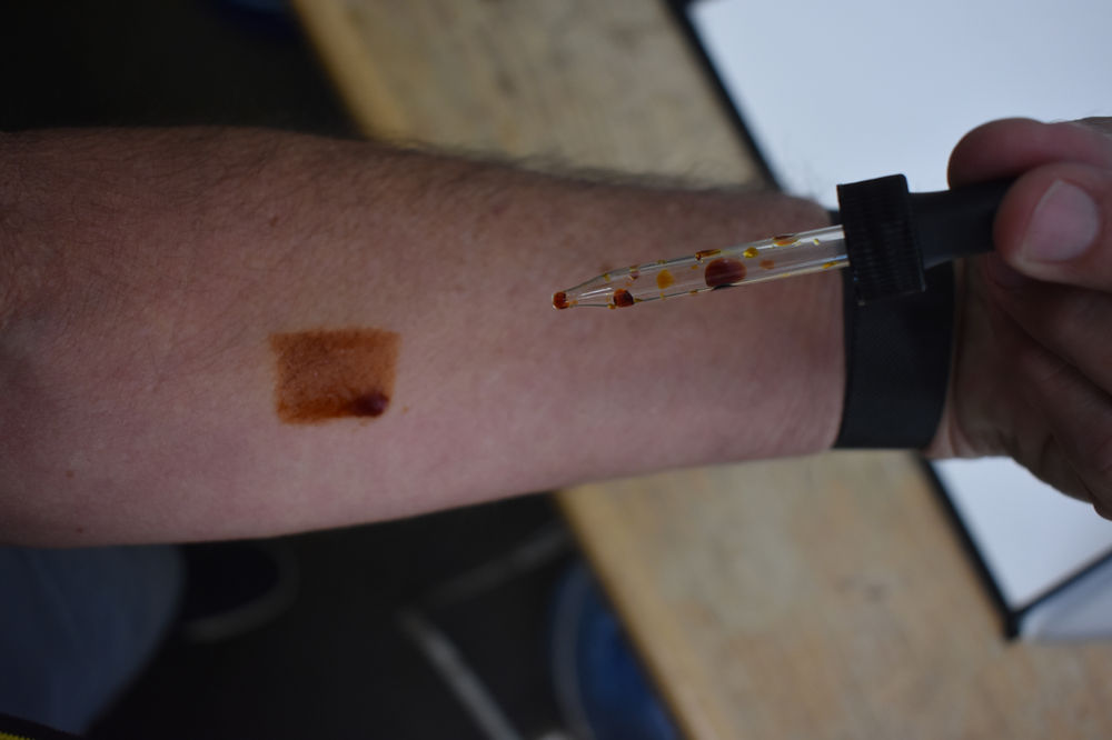 HOW TO PERFORM AN IODINE SKIN PATCH TEST