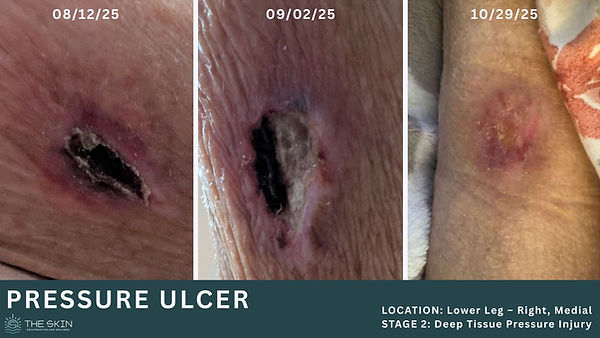 PRESSURE ULCER (1).jpg