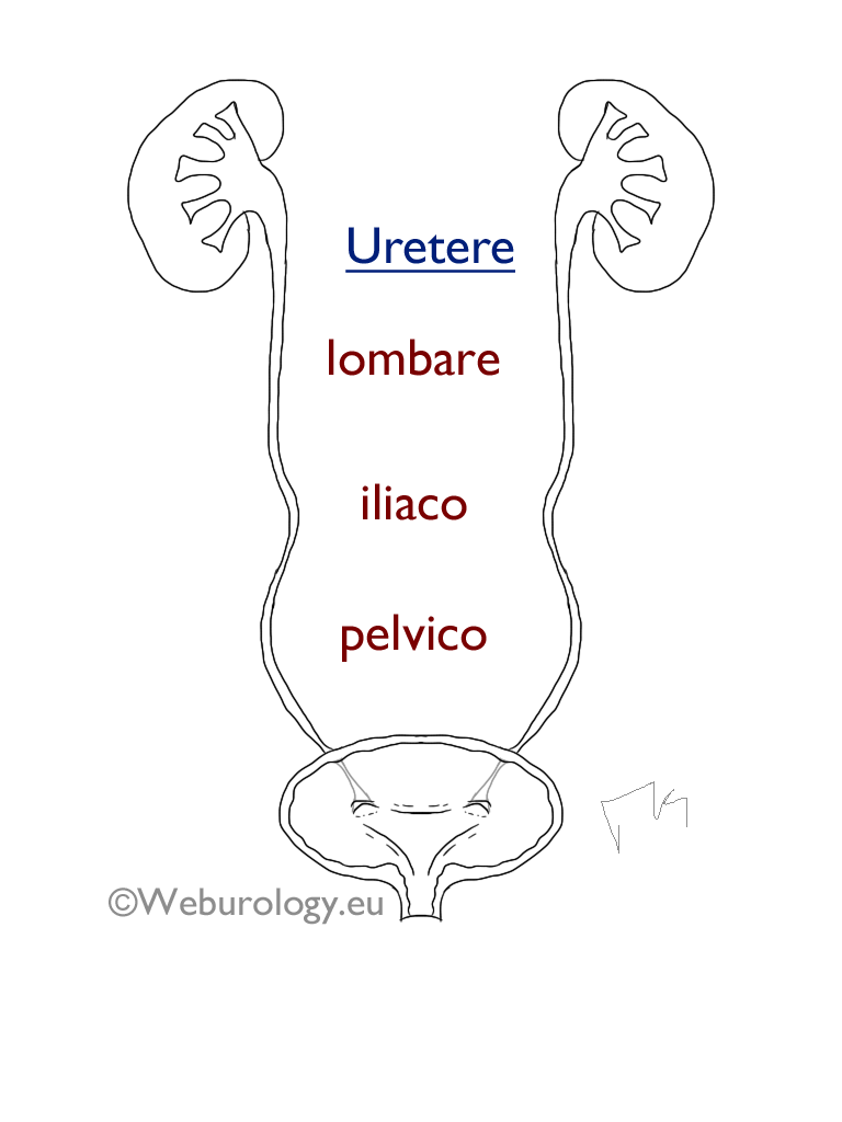 ostruzione ureterale ostruzione ureterale