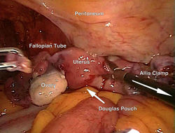 Laparoscopia