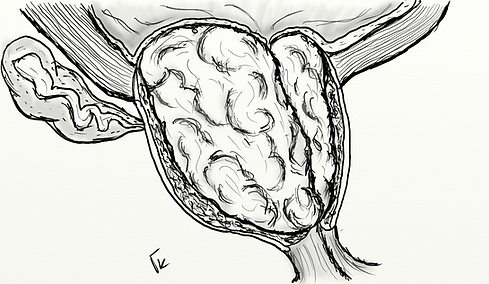 PROSTATA LATERALE GRANDE IPERTROFIA.png