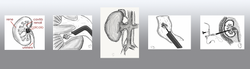 Disegni Endourologia