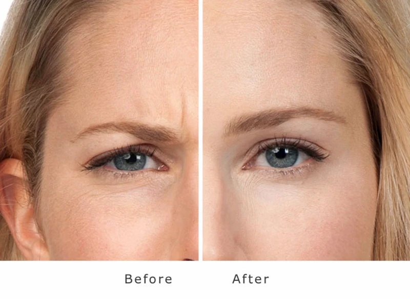 Före och efter behandling Glabella