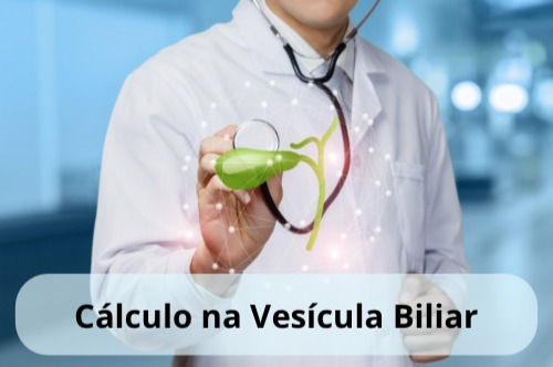 Cálculo na Vesícula Biliar