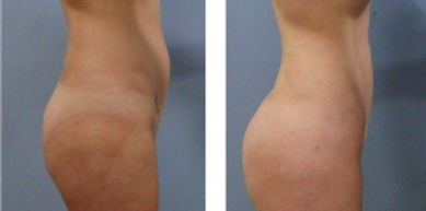 LIPOSUCCION COLOMBIA.PNG