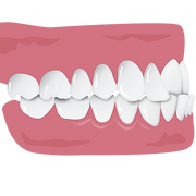 Crossbite.png