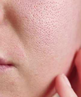 Uneven-Skin-Texture.png
