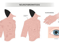 Koselugo: nuevo tratamiento que reduce tumores en pacientes con Neurofibromatosis Tipo 1