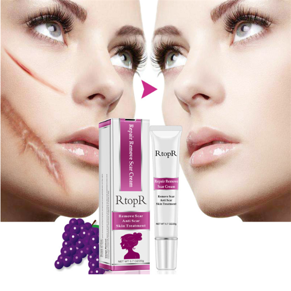 Thumbnail: Acne Scar Removal Cream for Skin Repair and Healing