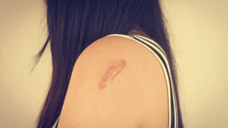 Close-up of a woman’s shoulder with a visible scar, representing the lasting impact of a physical injury.