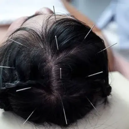 scalp acupuncture