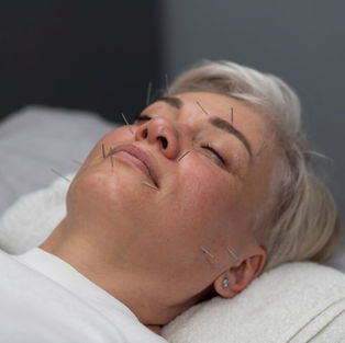 facial acupuncture on a young lady