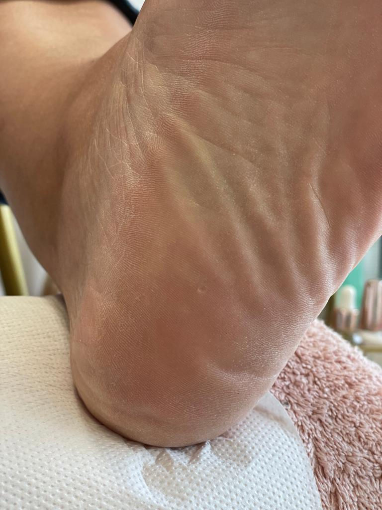 magic_peeling_avant