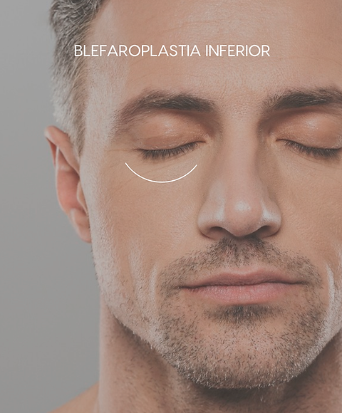 Blefaroplastia