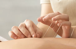 Acupuncturist inserting needles into patient's back for treatment.