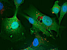 Glioblastoma nanomedicine crosses into brain in mice, eradicates recurring brain cancer