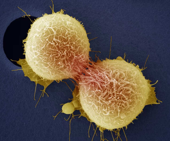 Cancer of the cervix is one of the most common cancers affecting women and can be fatal. Here, cervical cancer cells are dividing, as seen through a colored scanning electron micrograph. Steve Gschmeissner/Getty Images/Science Photo Library