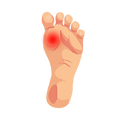 Image depicting Stage 1 of Diabetic foot ulcers, 