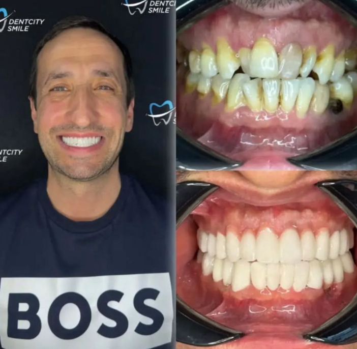 Perfect white teeth veneers Turkey result