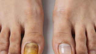 Clear, healthy-looking toenails are possible without oral antifungal pills.