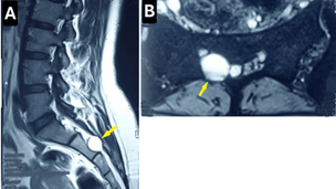 MRI Images of Tarlov Cysts